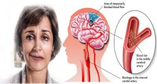 Illustration for article titled Obat Stroke Akibat Darah Tinggi